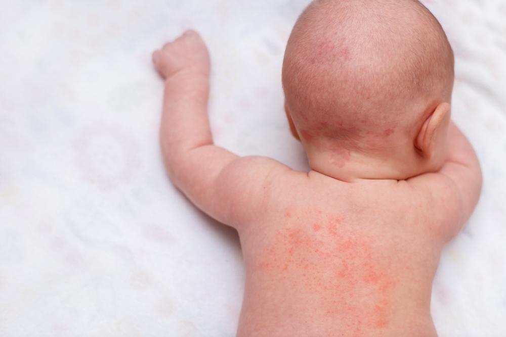 bébé sur le ventre avec eczéma sur le dos